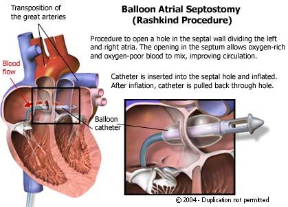 Balloon Atrial Septostomy (The Rashkind procedure) Goal: increase interatrial communication to allow more mixing of the two circulations Increases circulation of oxygenated blood until