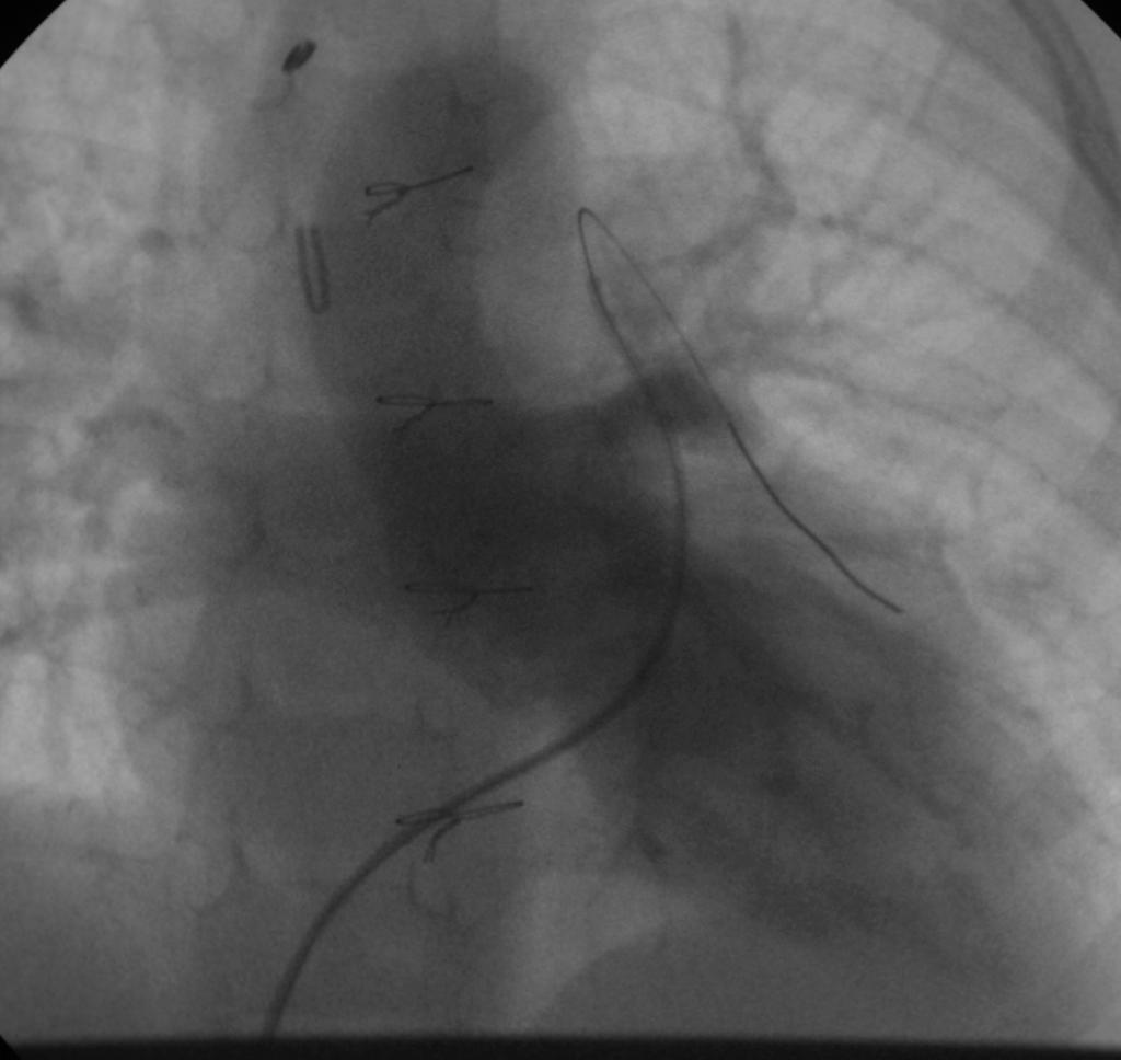 AP View Companion Patient #7: Post-ASO Cineangiograhy Findings: Aorta arising from LV Pulm veins Ao LA LA appendage