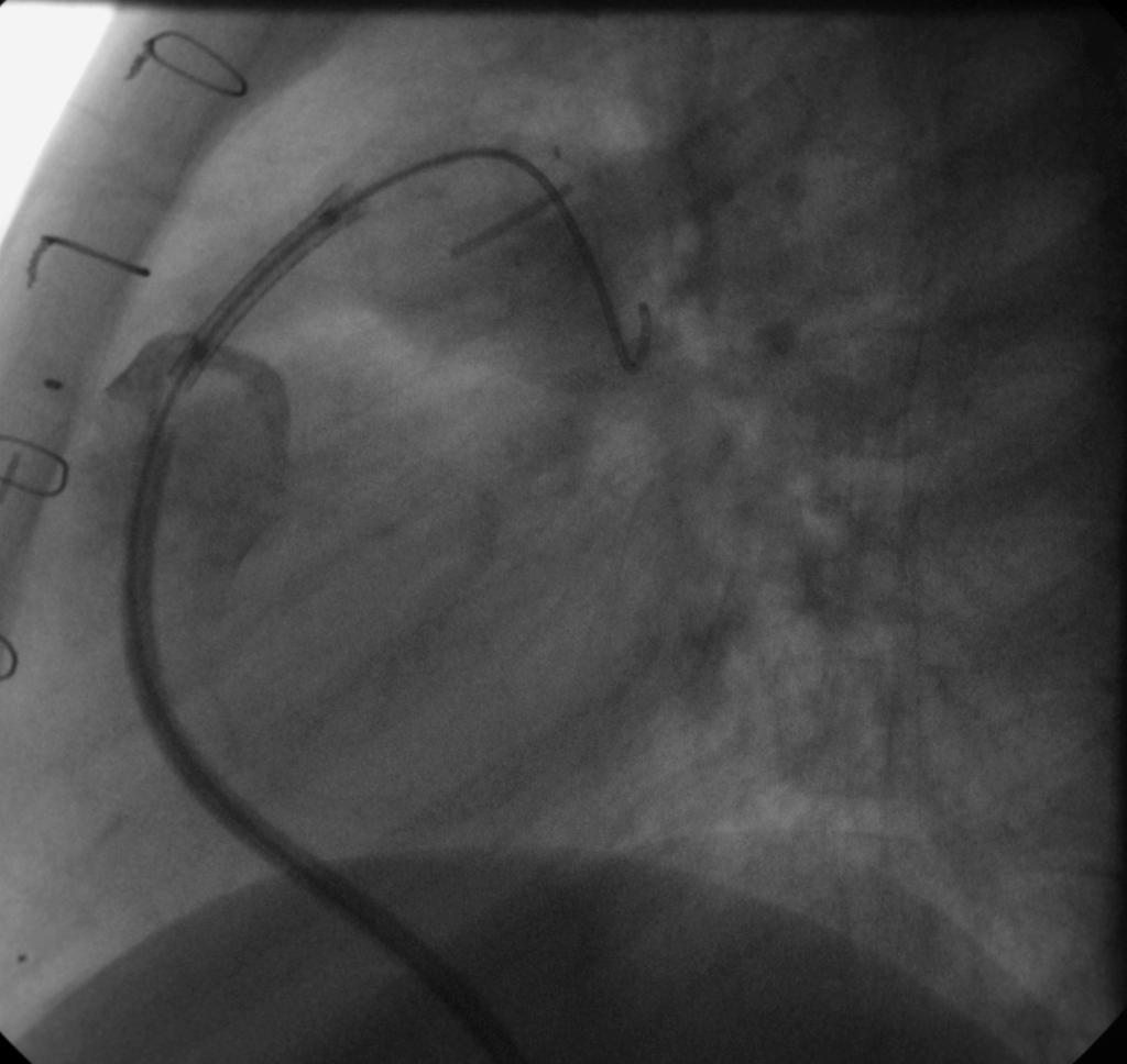 Treatment of Pulmonary Stenosis with Stent Placement
