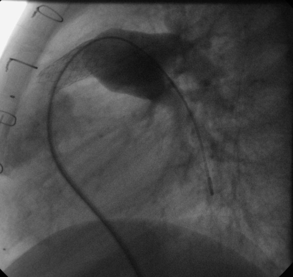 Inflation Stent Lateral View, Post Balloon Inflation