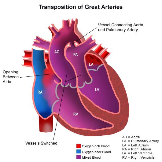 Anatomy of TGA Concordant atrioventricular connection, but ventriculoarterial discordance 2 parallel circulations Associated abnormalities: VSD in approx 50%, PS.