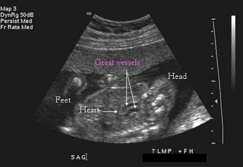 Most common way TGA is diagnosed in Boston Prenatal Diagnosis Companion Patient #1: TGA on Fetal Ultrasound