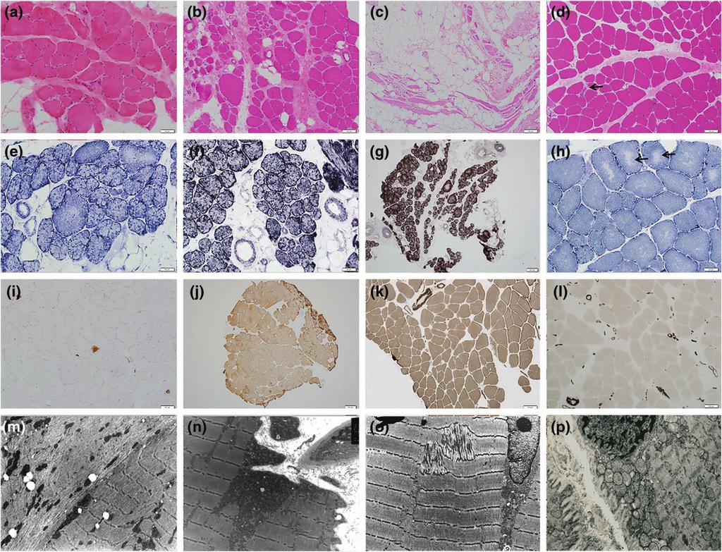 Cabrera-Serrano et al. Fig. 2. Muscle pathology. (a d) Haematoxylin and eosin.