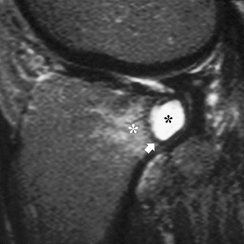 952 Kransdorf et al Fig. 13. Subchondral cyst in the proximal tibia.