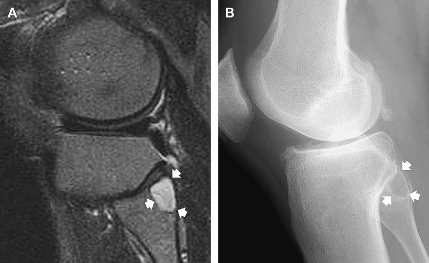 Note subtle adjacent edema-like signal (white asterisk) and marginal sclerosis (arrow). Two theories exist regarding the pathogenesis of subchondral cysts in osteoarthritis.