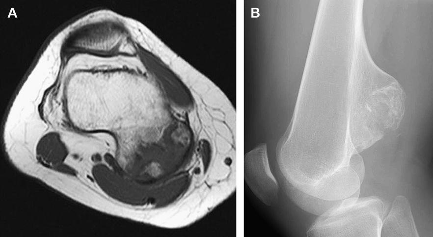 946 Kransdorf et al Fig. 3. Osteochondroma in the proximal tibia of a 33-year-old man.