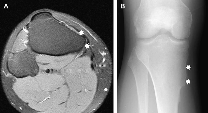 (B) Corresponding anteroposterior radiograph shows the sessile osteochondroma (arrows). T1-weighted images and greater than that of fat on T2-weighted images (fluid-like signal).