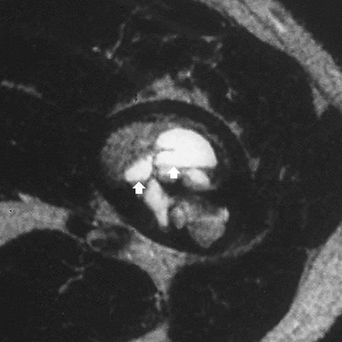 (B) Corresponding coronal fat-suppressed turbo T2-weighted (TR/TE; 4500/88) spin-echo MR image shows the lesion to have a low signal intensity.
