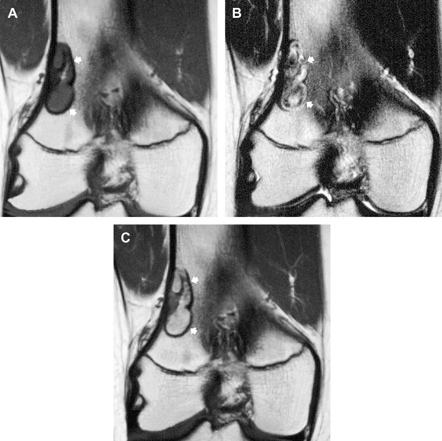 948 Kransdorf et al Fig. 7. Fibroxanthoma (nonossifying fibroma) in the distal femur of an adolescent boy.