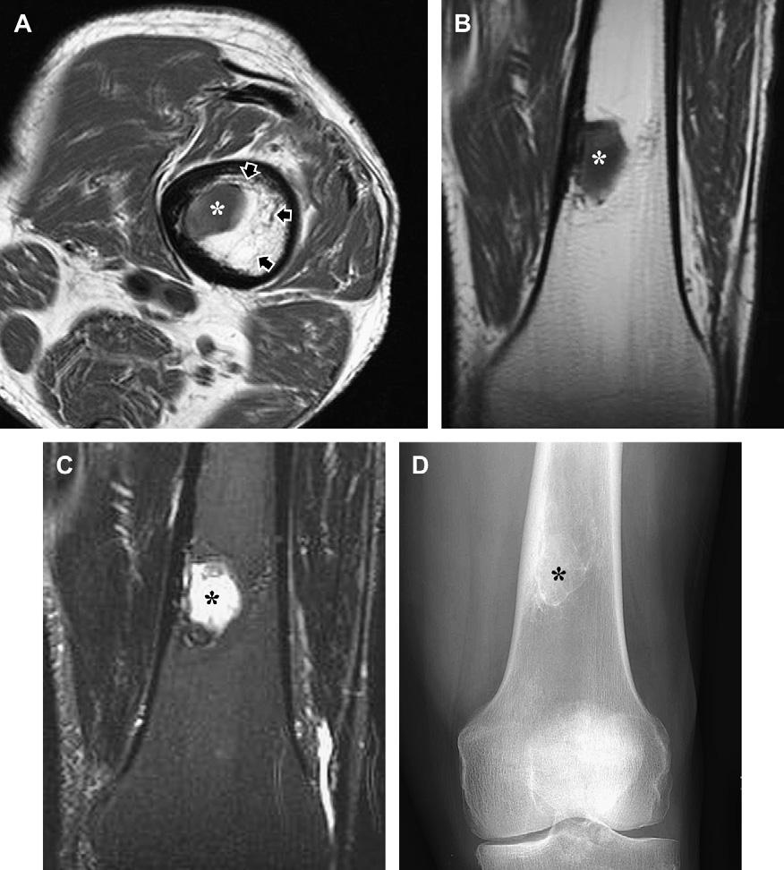 950 Kransdorf et al Fig. 10. Intraosseous lipoma with involutional change in the distal femur of a 72-year-old woman.