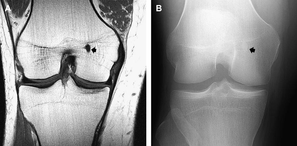 Incidental Osseous Lesions 951 Fig. 11. Bone island (enostosis) in the medial femoral epiphysis in a 22-year-old man.
