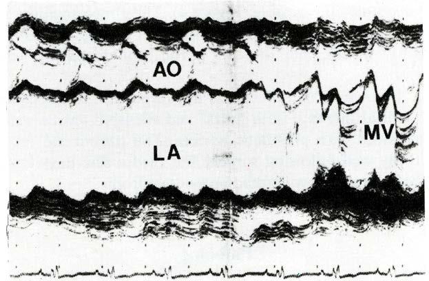 Figure 3. M-mode echocardiogram.