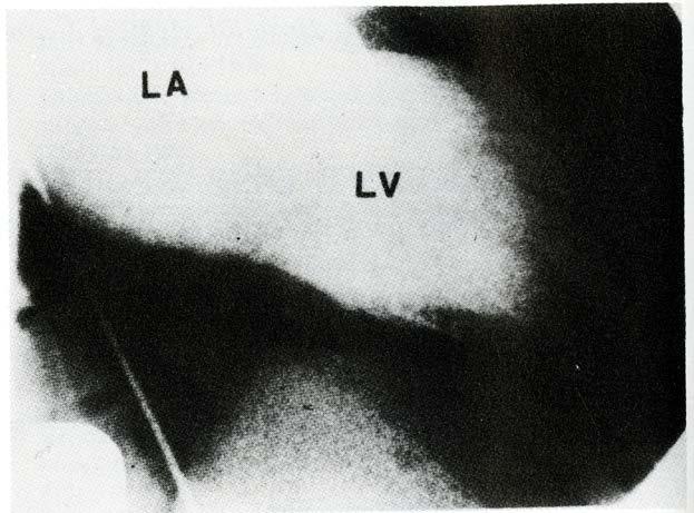 Left ventricular angiogram in the right anterior oblique position showing severe mitral valve incompetence.