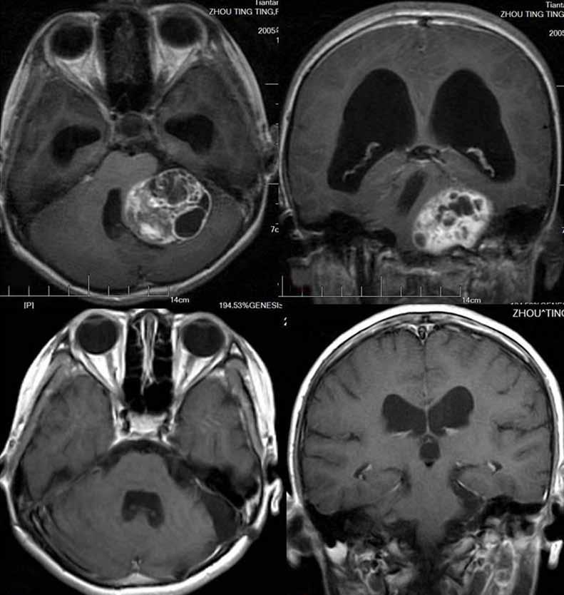 A B C D Figure 1: A, B) Preoperative MRI scan (axial and coronal views) with gadolinium showed a large acoustic neuroma in the left