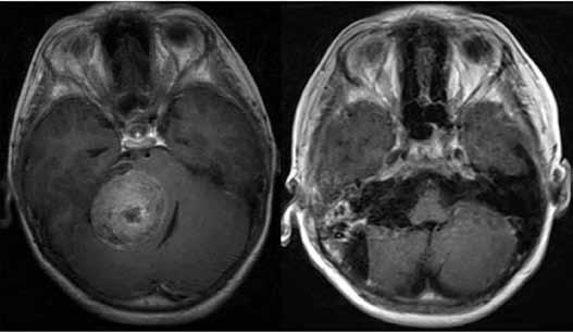 C, D) Postoperative MRI scan (axial and coronal views) with gadolinium taken 2 years postoperatively showed that the tumor was completely