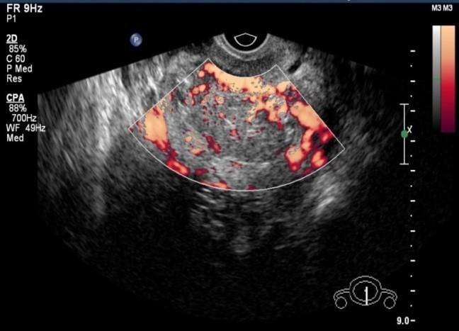 Fig 4(b): Appearance of endometrial carcinoma on power Doppler.