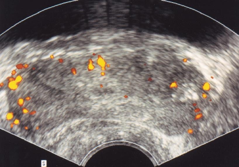 Sonographic Detection of Prostatic Cancer Fig. 2. Adenocarcinoma of the prostatic base with bilateral involvement in 61-year-old man. Gleason score was 6 (3 + 3).