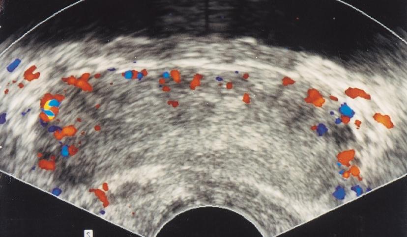 B, Transverse power sonogram also shows increased flow on right side. A B score in both groups was 6.7. The populations were similar in terms of age and PSA level. Color Doppler imaging yielded 14.