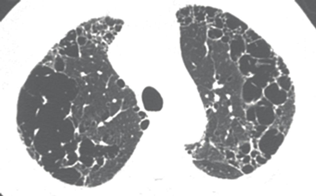 Pulmonary Medicine 3 (a) (b) Figure 1: Imaging from a 64-year-old man with CPFE. (a) HRCT of bilateral upper lung fields shows emphysema.