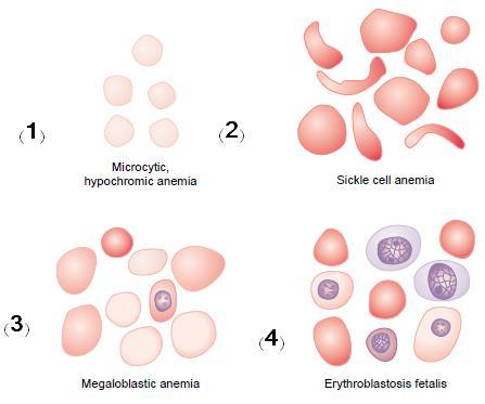 Figure (2): Red Blood Cells in Different types of Anemia.