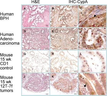 Human prostate biopsies representing BPH (A C) and adenocarcinoma (D F) were compared with mouse adult CD-1 prostates (G L, 15 weeks) and 12T-7f tumors (J L, 15 weeks).