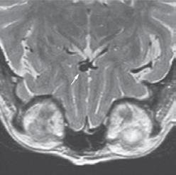 Incidental Findings on Brain MRI A B C D E F Figure 1. Incidental Findings on Brain MRI. Arrows indicate the abnormalities in each image.