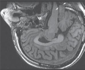Panel B shows a tonsillar herniation (type I Chiari malformation) more than 5 mm below the level of the foramen magnum on a T 1 -weighted sagittal image.