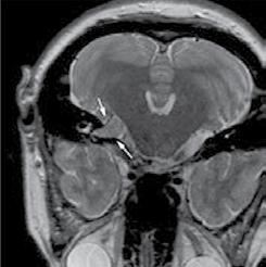 A large meningioma is shown on the T 1 -weighted axial image in Panel D. Panel E shows a large, chronic subdural hematoma on a proton-density weighted axial image.