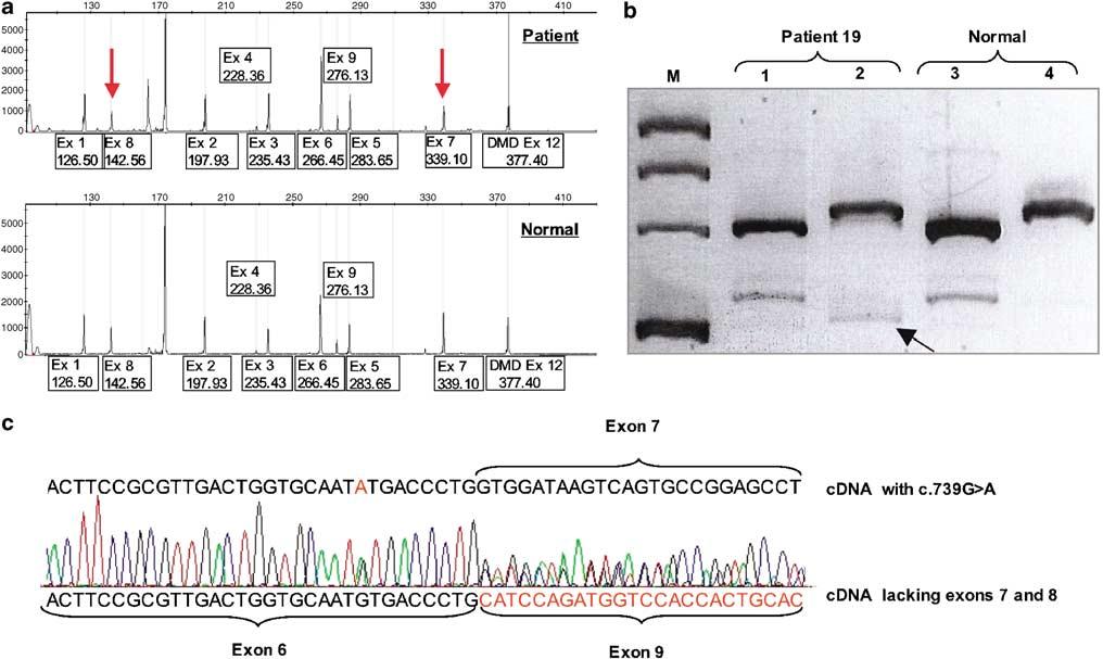 799 Figure 2 Heterozygous deletion of exons 7 and 8 of SGCA gene (patient 19, Table 2).