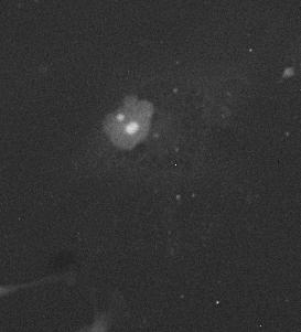 Phase image of KD cell demonstrates extreme vacuolization of the cytoplasm.