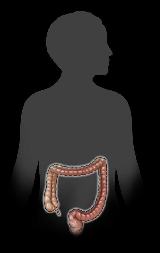 IBD Symptoms and Complications Crohn s Disease (CD) Ulcerative Colitis (UC) Can affect any portion of the gastrointestinal tract, predominantly the ileum 1,2 Potential transmural involvement of all