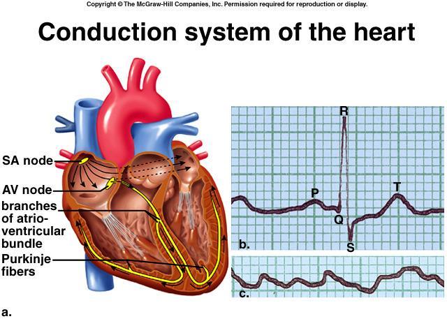 ventricles The atria contract together, then the ventricles both contract Heart Attack Plaque formation