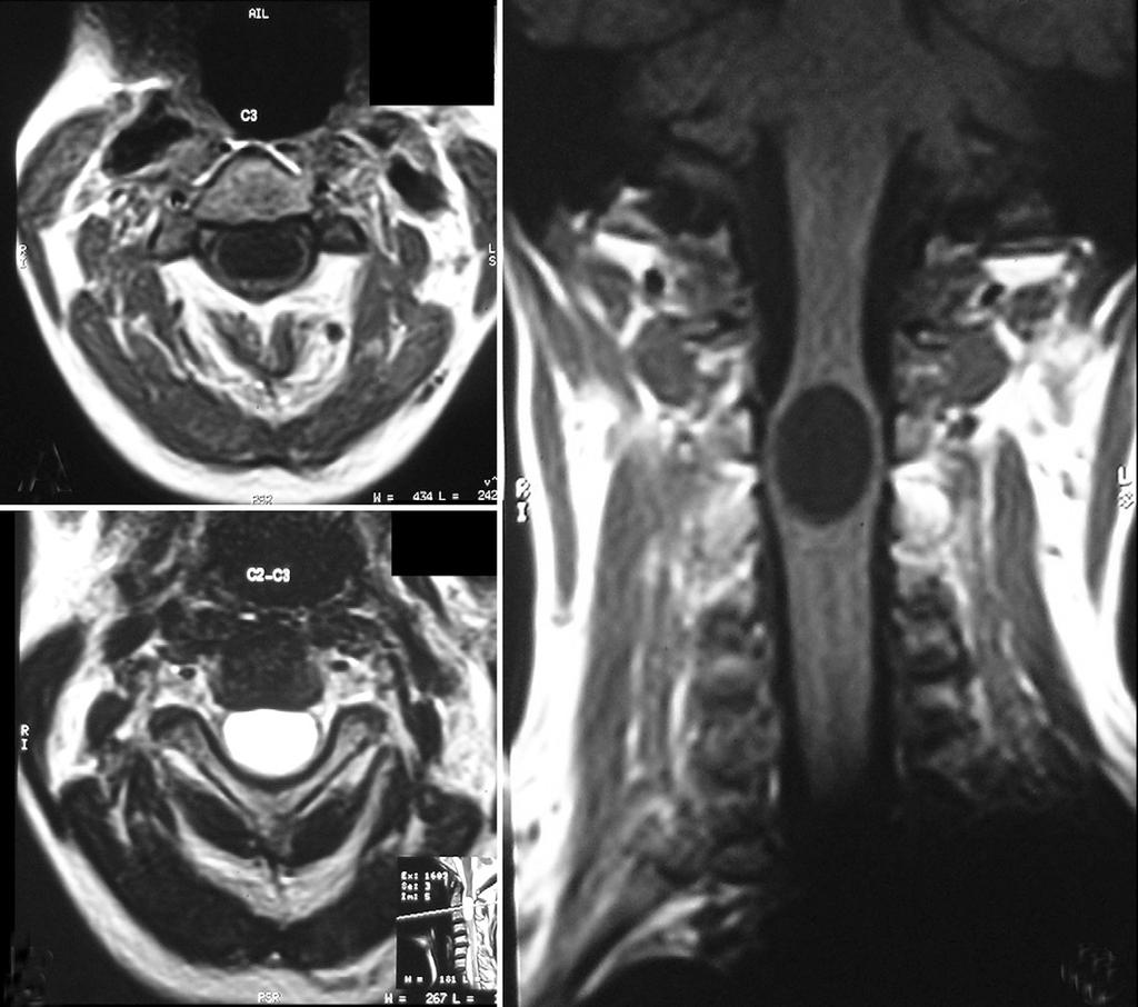 Preoperative MRI images demonstrating a well define cervical intramedullary lesion on hypointense T1W