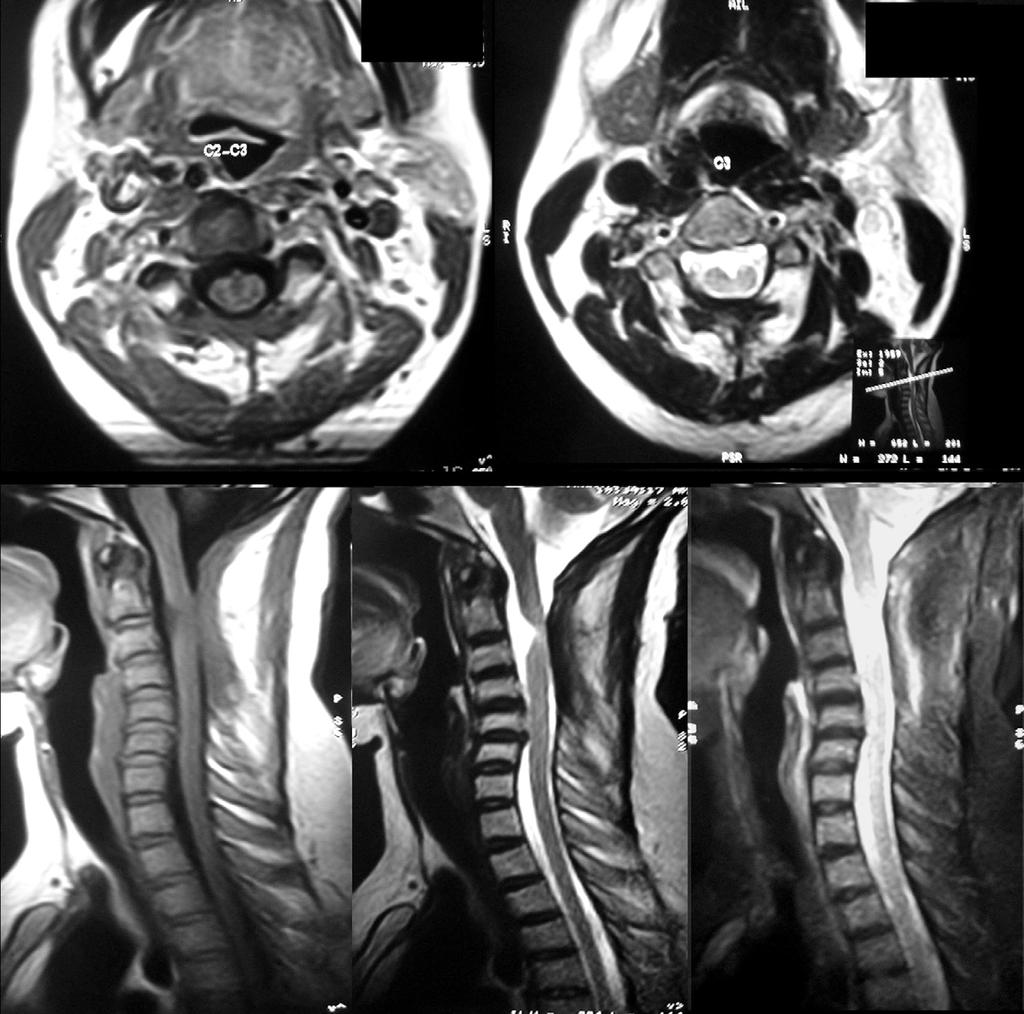 62 / ASJ: Vol. 5, No. 1, 2011 Fig. 5. Follow up magnetic resonance imaging showing complete excision of the lesion and thinning of the cord at that level.