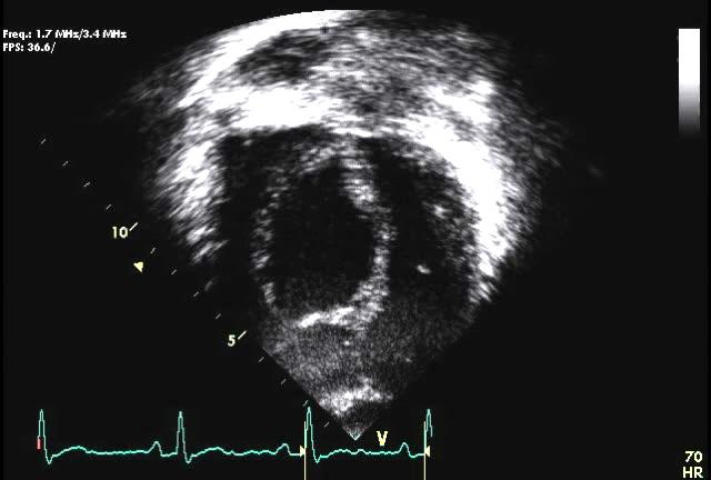 The Valve and Its Orifice has been displaced anteriorly and apically toward the RVOT Failed Delamination