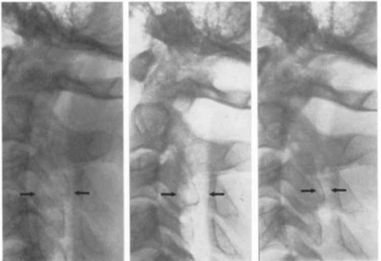 a l b f c I Fig. 39. Puncture 8. Case 17. Hydromyelia. Gas in cyst only. Films taken immediately after puncture (a), after 24 hours (b) and after 6 days (c). Gradual decrease in sagittal diameter.