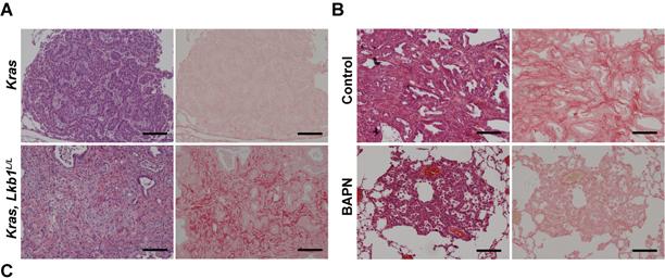 Figure S11. Excess collagen deposition increases lung cancer progression through activation of 1 integrin signaling.