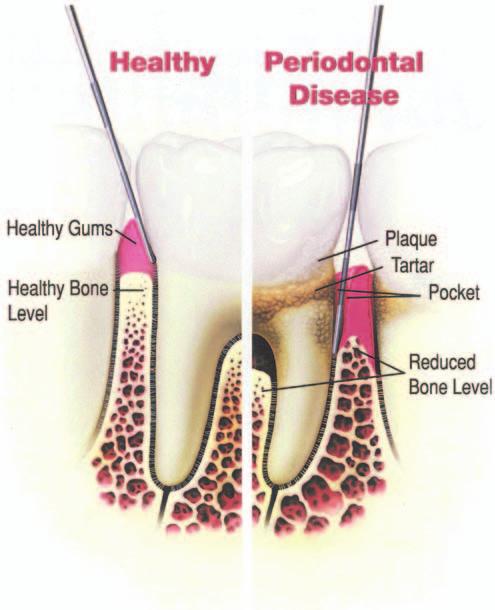 If you notice any of these symptoms, you should see a periodontist for a complete periodontal examination.