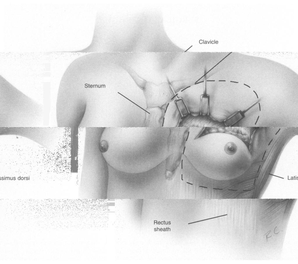 The thickness of the flap will vary with the amount of subcutaneous fat present. Manual retraction of the breast tissue away from the skin tends to show this plane quite effectively.