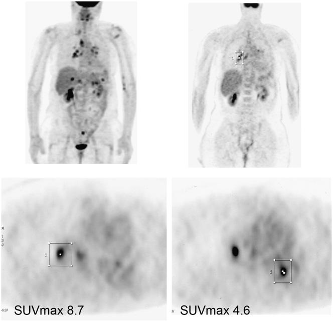 an impure scan, compared with % of patients with a pure scan (P, 0.001; x 2 test), had malignancy.