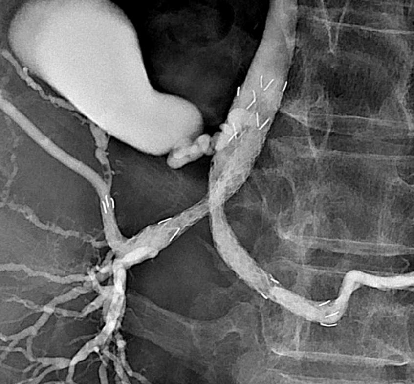 48 Gastrointestinal Intervention 2016 5(1), 47 51 Percutaneous ilateral iliary Stent Placement Palliative stent placement for advanced hilar malignancies is usually accomplished through two separate