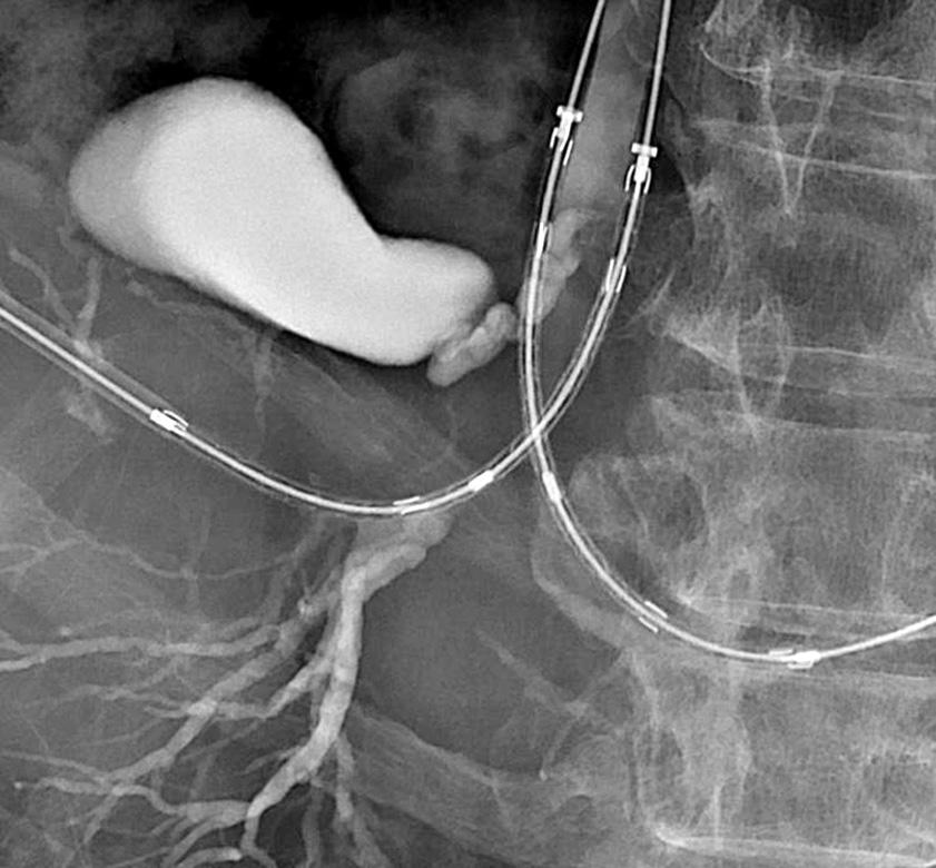 6 18 Two techniques have been developed for the percutaneous placement of bilateral metallic stents, sideby-side and stent-in-stent deployment techniques.