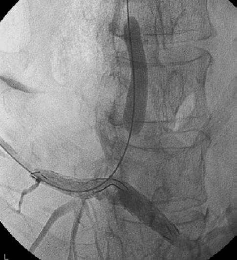 This parallel arrangement, however, may prevent full expansion of metallic stents at and below the hepatic confluence.