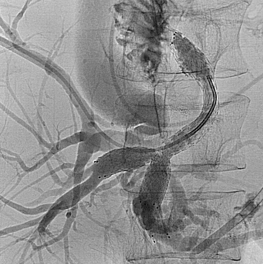 Percutaneous Unilateral iliary Stent Placement The indications for percutaneous unilateral biliary stent placement are no/little functional liver parenchyma due to huge tumor and unilateral portal