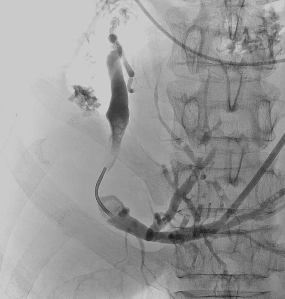 portal vein occlusion caused by advanced hilar malignancy, obviating bilateral stent placement in these patients, because the hepatic lobe with portal vein occlusion caused by advanced hilar