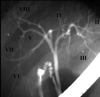 Costamagna et al Figure 2) Bismuth-Corlette classification of hilar tumours Figure 1) Retrograde cholangiography showing correspondence between intrahepatic ducts and hepatic segments TABLE 1