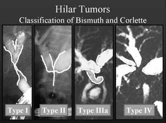 hepatic confluence 2 IIIa Stricture interrupts the main and the right 3 secondary hepatic confluence IIIb Stricture interrupts the main and the left 3 secondary hepatic confluence IV Primary and