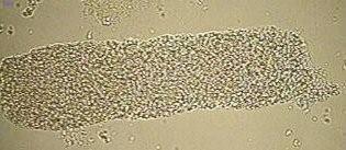 Microscopic Sediment Casts Granular casts Urinary Casts: