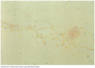 Urinary Casts: Confusing Sediment - Yeast SM-stained yeast with pseudohyphae and WBCs