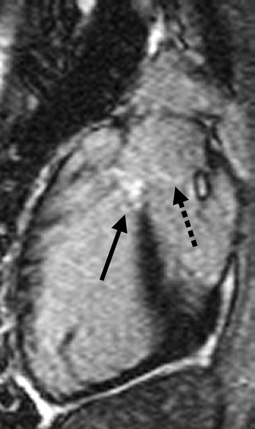 Note the prominent delayed enhancement along the anterior wall of the right ventricular pulmonary artery conduit (open arrows) and the ventricular septal defect patch (long solid arrow).
